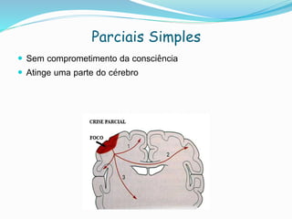 Parciais Simples
 Sem comprometimento da consciência
 Atinge uma parte do cérebro
 