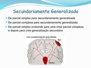 Secundariamente Generalizada
 De parcial simples para secundariamente generalizada
 De parcial complexa para secundariamente generalizada
 De parcial simples evoluindo para uma crise parcial complexa
e depois para uma generalização secundária
 