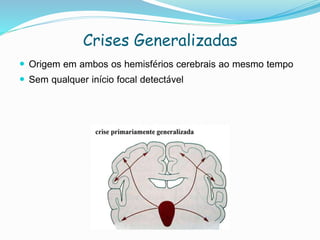 Crises Generalizadas
 Origem em ambos os hemisférios cerebrais ao mesmo tempo
 Sem qualquer início focal detectável
 