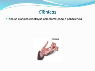 Clônicas
 Abalos clônicos repetitivos comprometendo a consciência
 