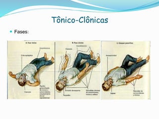 Tônico-Clônicas
 Fases:
 