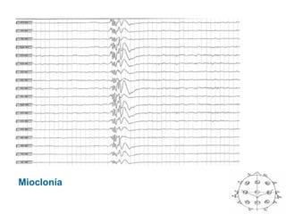 Mioclonía
 