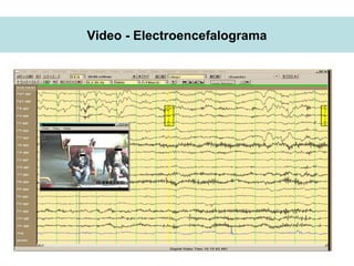 Video - Electroencefalograma
 