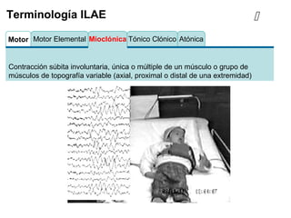 Motor Tónico Clónico AtónicaMioclónicaMotor Elemental
Contracción súbita involuntaria, única o múltiple de un músculo o grupo de
músculos de topografía variable (axial, proximal o distal de una extremidad)
Terminología ILAE 
 