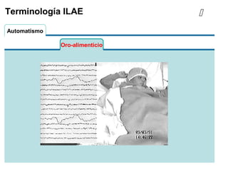 Oro-alimenticio
Automatismo
Terminología ILAE 
 