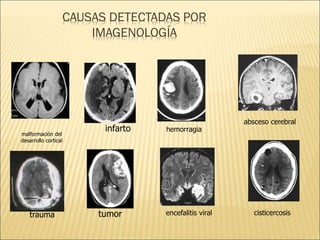 CAUSAS DETECTADAS POR
IMAGENOLOGÍA
infarto
trauma
malformación del
desarrollo cortical
tumor encefalitis viral
absceso cerebral
hemorragia
cisticercosis
 