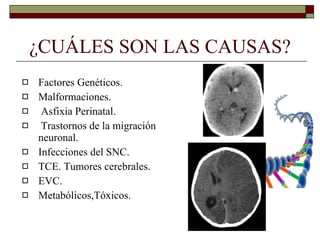 ¿CUÁLES SON LAS CAUSAS? Factores Genéticos. Malformaciones. Asfixia Perinatal. Trastornos de la migración neuronal. Infecciones del SNC. TCE. Tumores cerebrales.  EVC. Metabólicos,Tóxicos. 