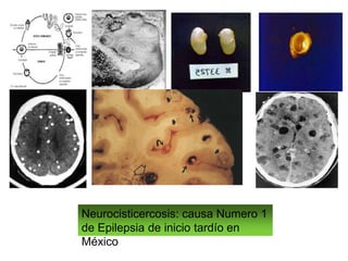 Neurocisticercosis: causa Numero 1
de Epilepsia de inicio tardío en
México
 