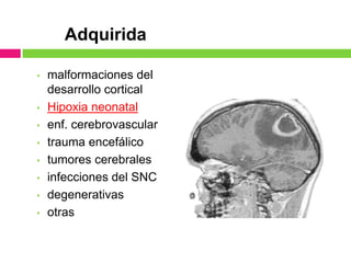 Adquirida

•   malformaciones del
    desarrollo cortical
•   Hipoxia neonatal
•   enf. cerebrovascular
•   trauma encefálico
•   tumores cerebrales
•   infecciones del SNC
•   degenerativas
•   otras
 