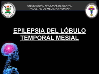 EPILEPSIA DEL LÓBULO
TEMPORAL MESIAL
UNIVERSIDAD NACIONAL DE UCAYALI
FACULTAD DE MEDICINA HUMANA
I.M. JAIR LUILLI IRARICA GARCIA
 