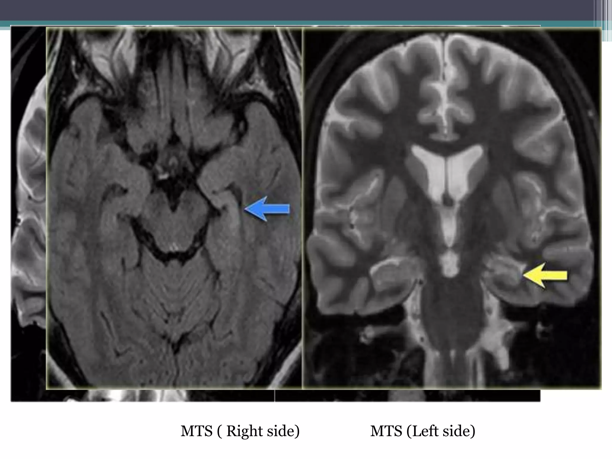 MTS ( Right side) MTS (Left side)
 