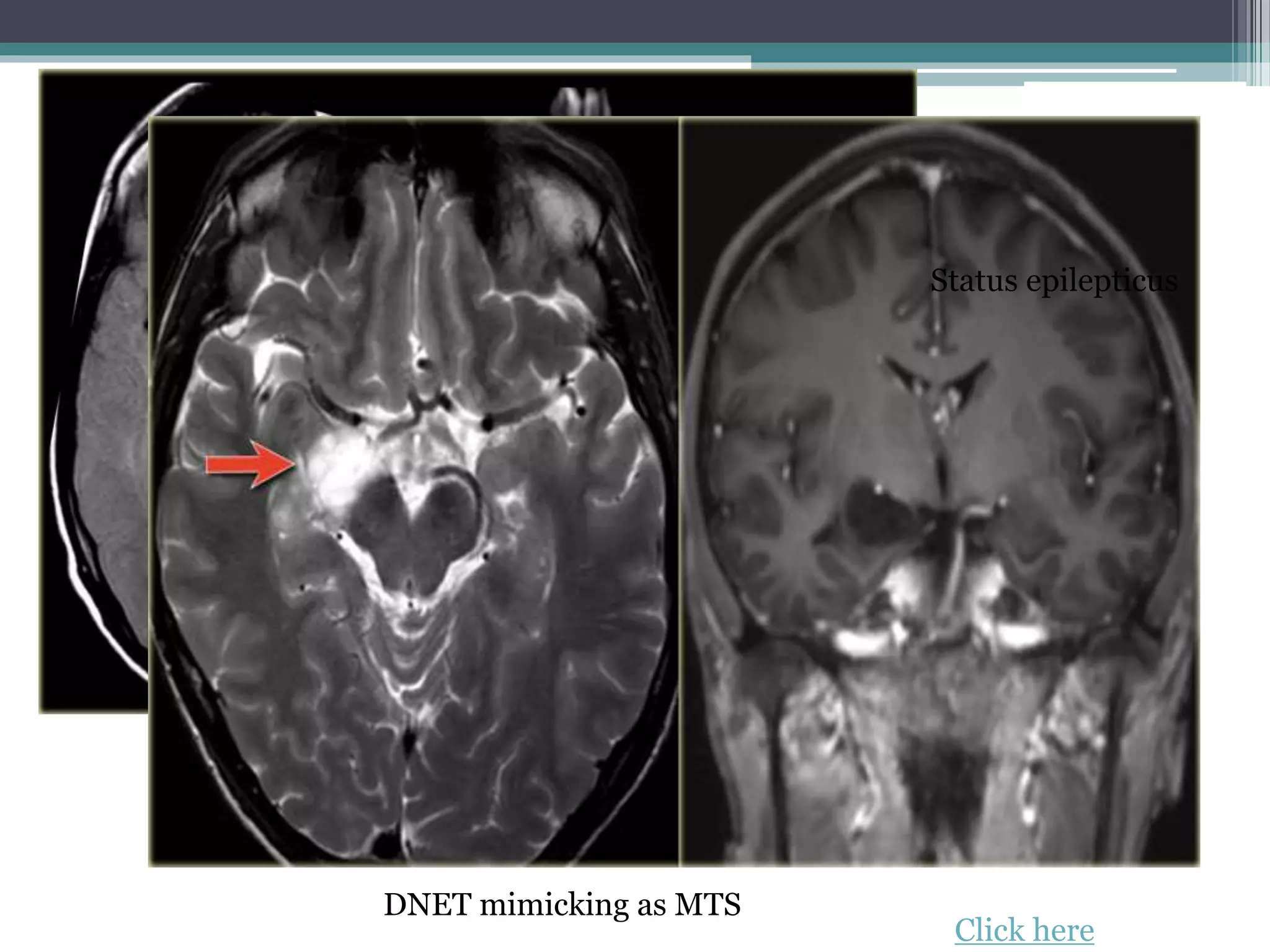 Status epilepticus
DNET mimicking as MTS
Click here
 