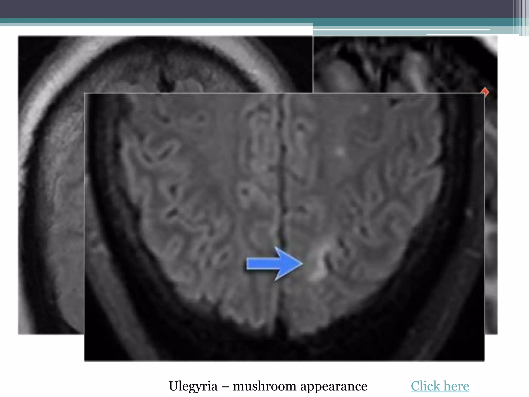 Ulegyria – mushroom appearance Click here
 