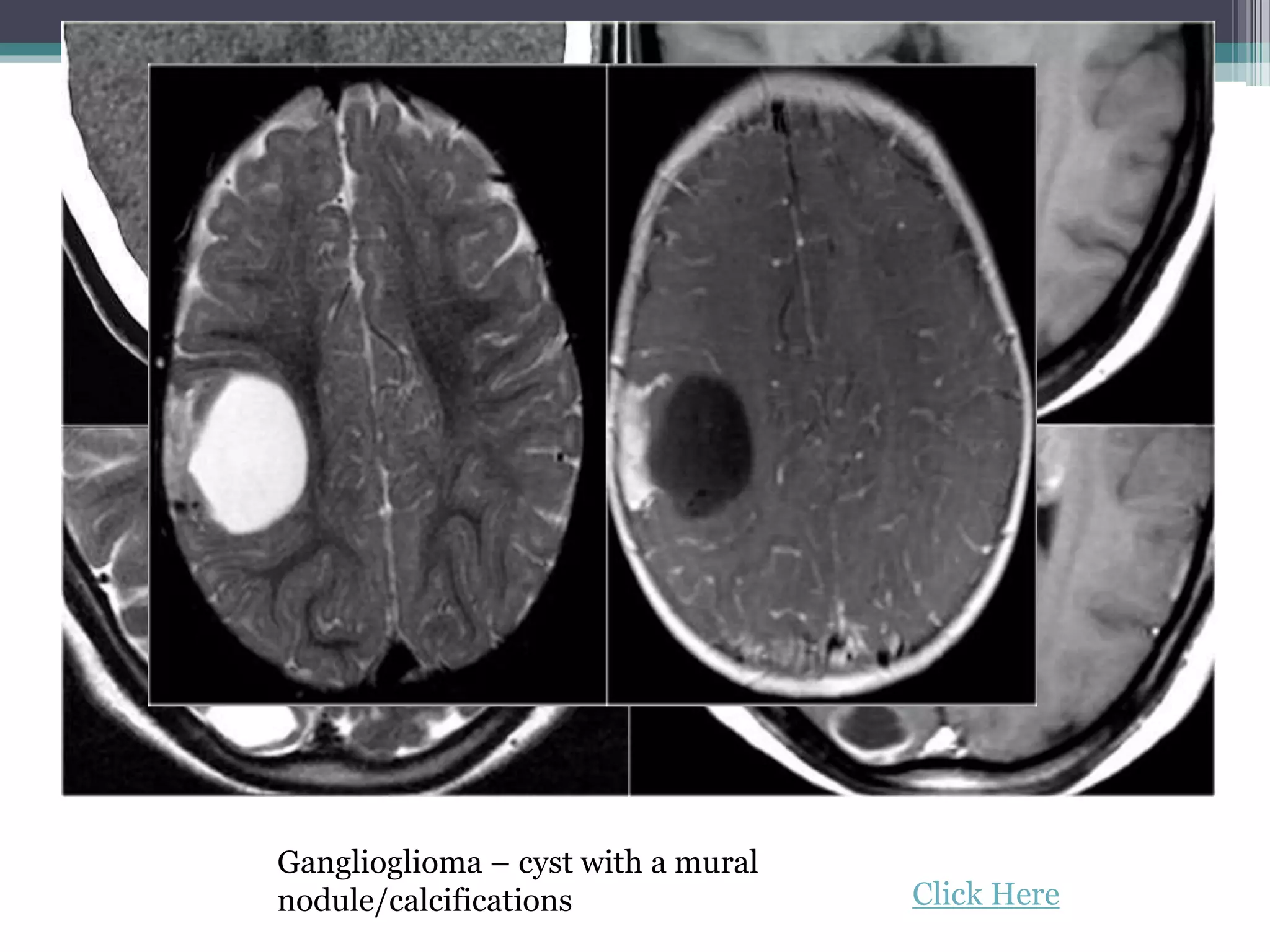 Ganglioglioma – cyst with a mural
nodule/calcifications Click Here
 
