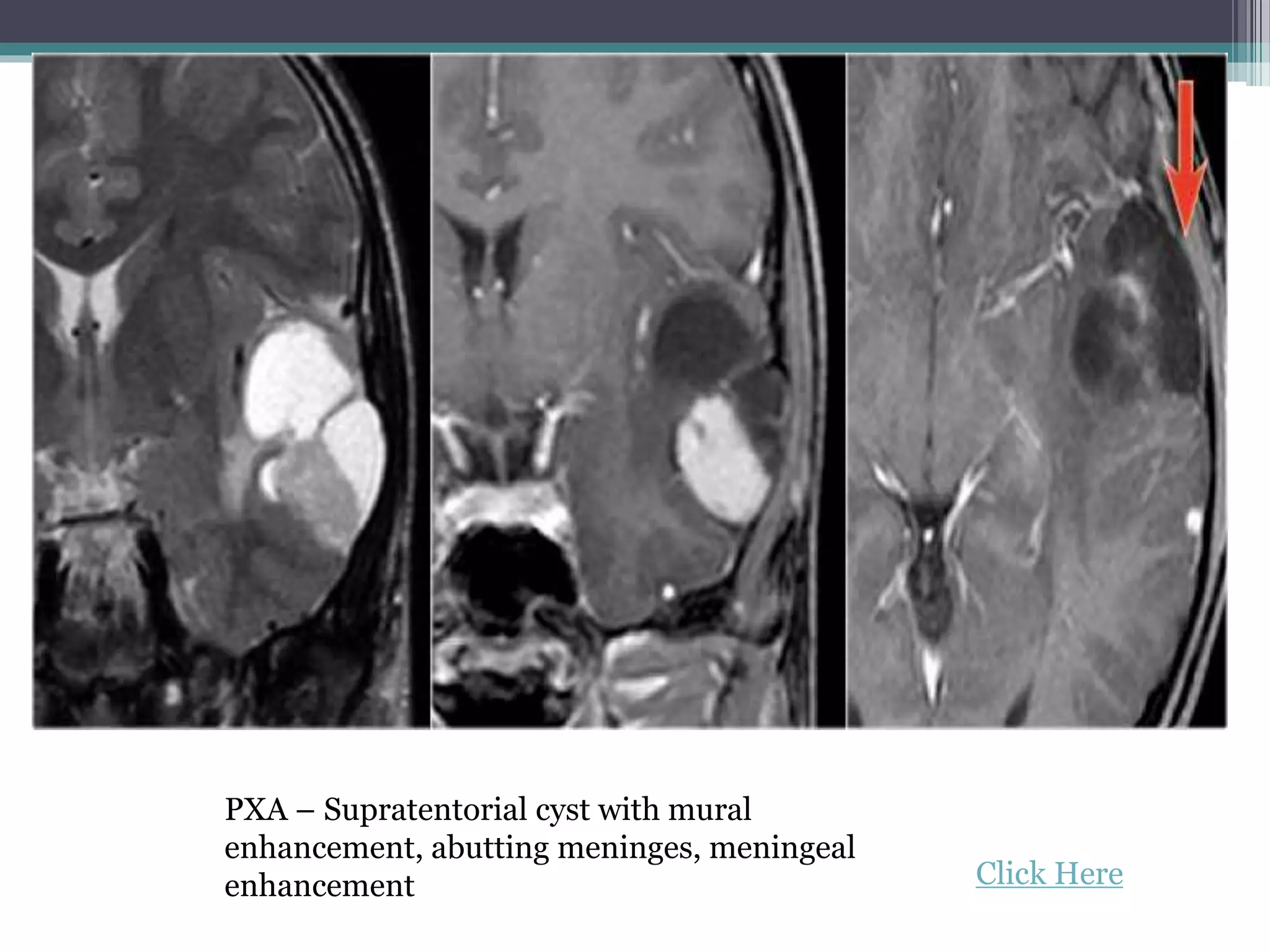 PXA – Supratentorial cyst with mural
enhancement, abutting meninges, meningeal
enhancement Click Here
 