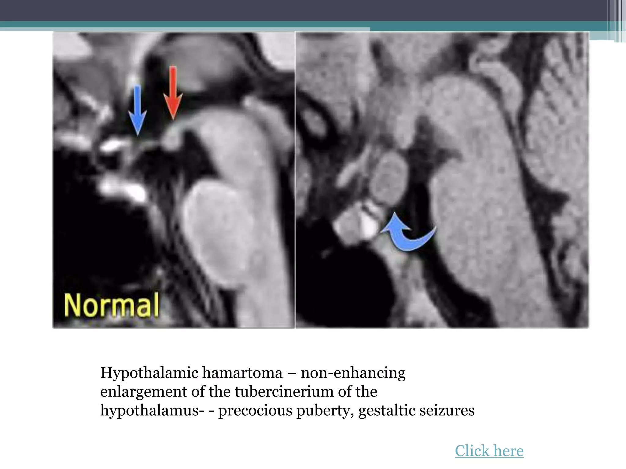 Hypothalamic hamartoma – non-enhancing
enlargement of the tubercinerium of the
hypothalamus- - precocious puberty, gestaltic seizures
Click here
 