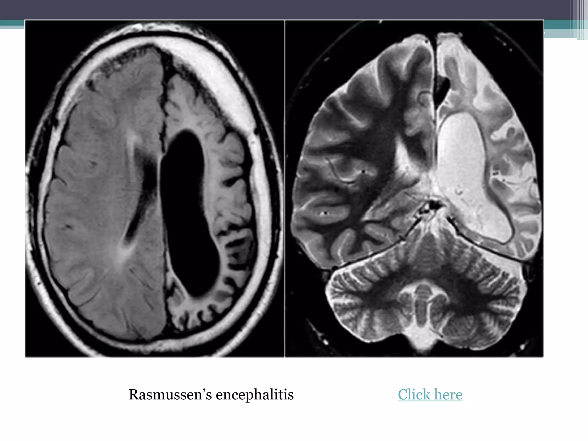 Rasmussen’s encephalitis Click here
 
