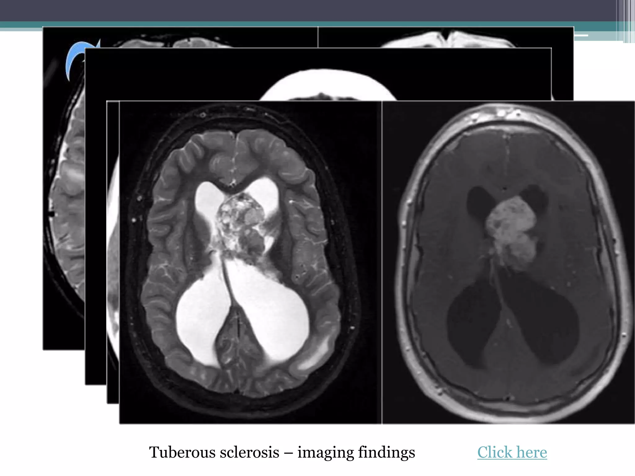 Tuberous sclerosis – imaging findings Click here
 