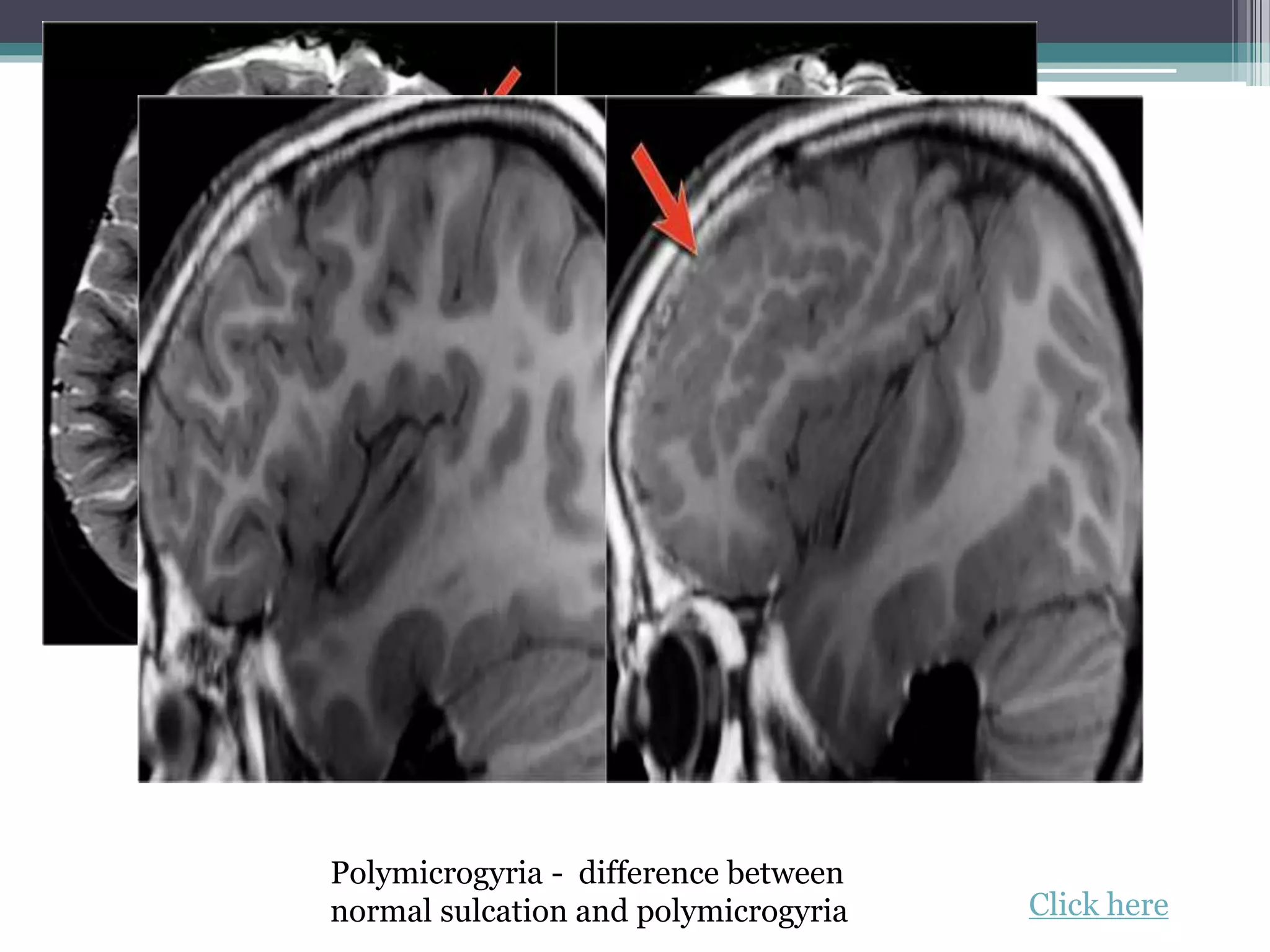 Polymicrogyria - difference between
normal sulcation and polymicrogyria Click here
 
