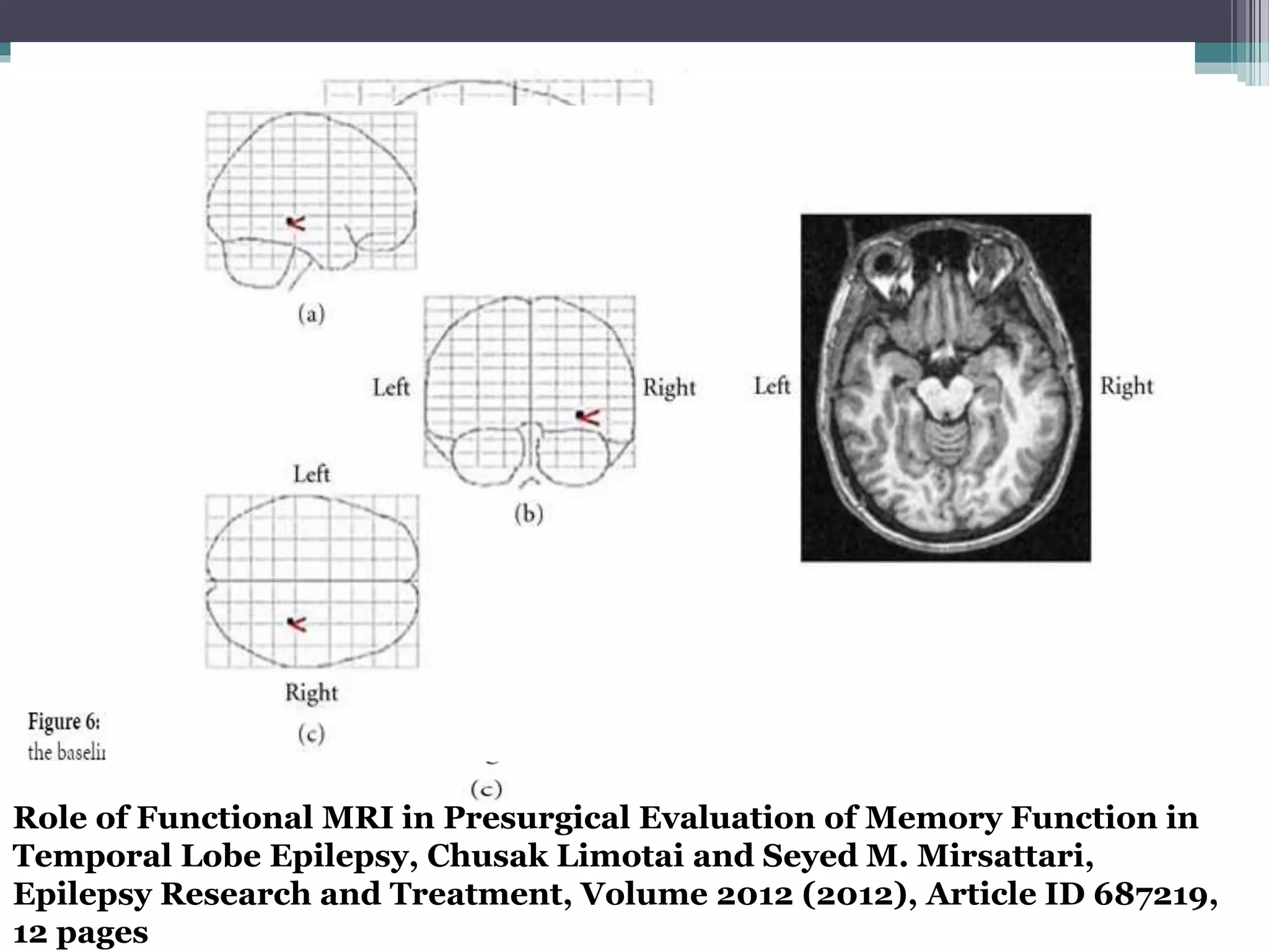 Role of Functional MRI in Presurgical Evaluation of Memory Function in
Temporal Lobe Epilepsy, Chusak Limotai and Seyed M. Mirsattari,
Epilepsy Research and Treatment, Volume 2012 (2012), Article ID 687219,
12 pages
 