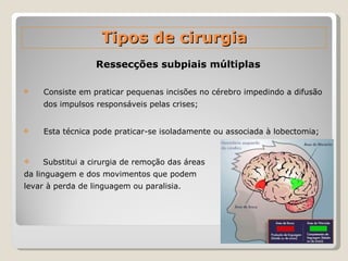 Ressecções subpiais múltiplas Consiste em praticar pequenas incisões no cérebro impedindo a difusão dos impulsos responsáveis pelas crises;  Esta técnica pode praticar-se isoladamente ou associada à lobectomia; Tipos de cirurgia Substitui a cirurgia de remoção das áreas da linguagem e dos movimentos que podem levar à perda de linguagem ou paralisia. 