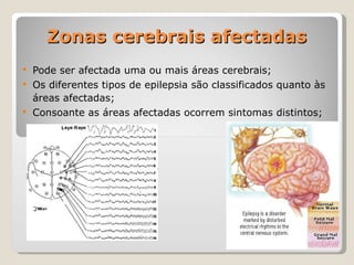 Zonas cerebrais afectadas Pode ser afectada uma ou mais áreas cerebrais; Os diferentes tipos de epilepsia são classificados quanto às áreas afectadas; Consoante as áreas afectadas ocorrem sintomas distintos; 