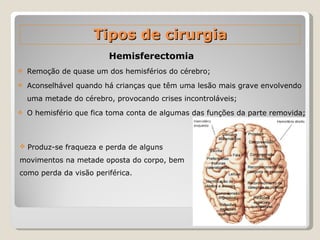 Hemisferectomia Remoção de quase um dos hemisférios do cérebro; Aconselhável quando há crianças que têm uma lesão mais grave envolvendo uma metade do cérebro, provocando crises incontroláveis; O hemisfério que fica toma conta de algumas das funções da parte removida; Tipos de cirurgia Produz-se fraqueza e perda de alguns movimentos na metade oposta do corpo, bem como perda da visão periférica. 