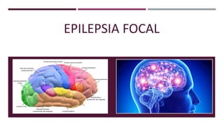 EPILEPSIA FOCAL
 