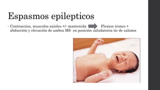 Espasmos epilepticos
• Contraccion, musculos axioles +/- mantenida Flexion tronco +
abducción y elevación de ambos MS en posición saludatoria tic de salamn
 