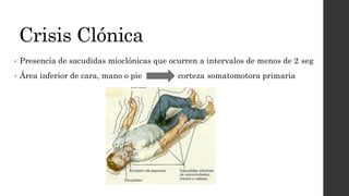 Crisis Clónica
• Presencia de sacudidas mioclónicas que ocurren a intervalos de menos de 2 seg
• Área inferior de cara, mano o pie corteza somatomotora primaria
 