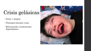 Crisis gelásicas
• Gelos = alegría
• Principal síntoma: risas
• Relacionada a hamartoma
hipotalámico
 