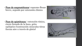 • Fase de emprostótonos: espasmo flexor
breve, seguido por extensión clónica
• Fase de opistótonos : extensión tónica,
cierre forzado de la boca, grito
epiléptico (contracción músculos tórax
fuerza aire a través de glotis)
 