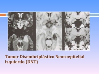 Tumor Disembriplástico Neuroepitelial Izquierdo (DNT) 
