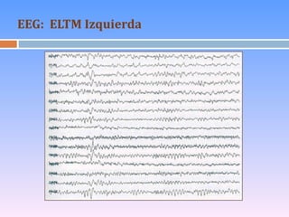 EEG:  ELTM Izquierda 