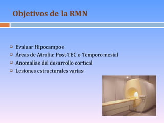 Objetivos de la RMN   <ul><li>Evaluar Hipocampos </li></ul><ul><li>Áreas de Atrofia: Post-TEC o Temporomesial </li></ul><u...