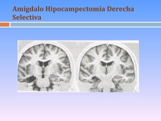 Amígdalo Hipocampectomía Derecha  Selectiva 