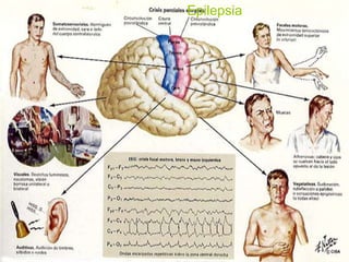 Epilepsia
 