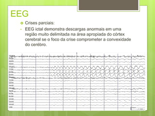 EEG
 Crises parciais:
• EEG ictal demonstra descargas anormais em uma
região muito delimitada na área apropiada do córtex
cerebral se o foco da crise comprometer a convexidade
do cerébro.
 