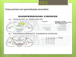 EEG
Crises parciais com generalização secundária:
 