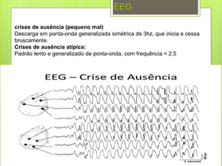 crises de ausência (pequeno mal)
Descarga em ponta-onda generalizada simétrica de 3hz, que inicia e cessa
bruscamente.
Crises de ausência atípica:
Padrão lento e generalizado de ponta-onda, com frequência < 2,5
EEG
 