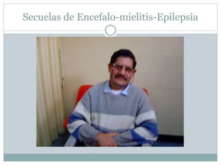 Secuelas de Encefalo-mielitis-Epilepsia
 