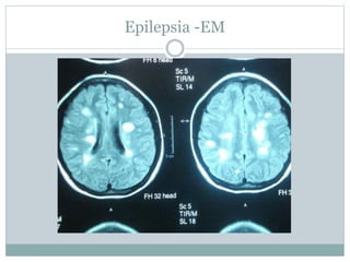 Epilepsia -EM
 