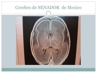 Cerebro de SENADOR de Mexico
 