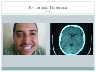 Esclerosis Tuberosa
 