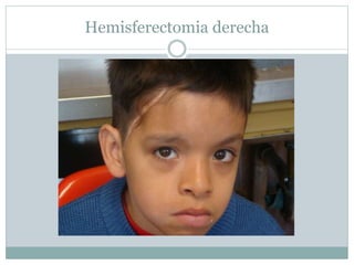 Hemisferectomia derecha
 
