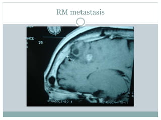RM metastasis
 