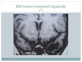 RM tumor temporal izquierdo
 