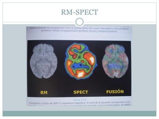 RM-SPECT
 
