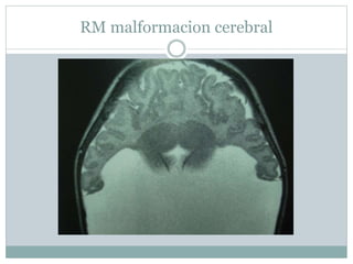 RM malformacion cerebral
 