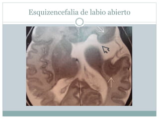 Esquizencefalia de labio abierto
 
